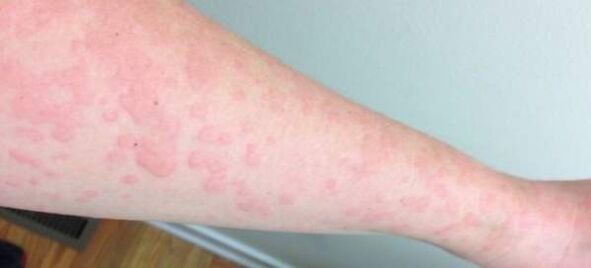 As alerxias cutáneas son un sinal da presenza de parasitos no corpo